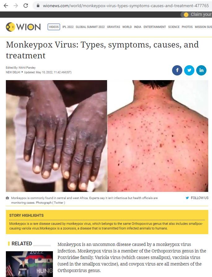   Picture of Monkey Pox for comparison with Pustules caused by Kaposi's sarcoma:             Monkeypox is commonly found in central and west Africa. Experts say it isn't infectious but health officials are monitoring cases.                        https://www.wionews.com/world/monkeypox-virus-types-symptoms-causes-and-treatment-477765      #MonkeyPox       